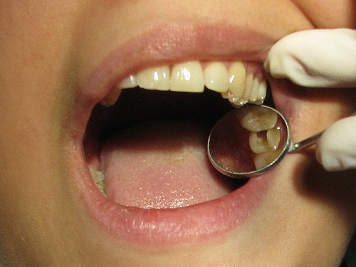 مراقبت های پس از درمان ریشه